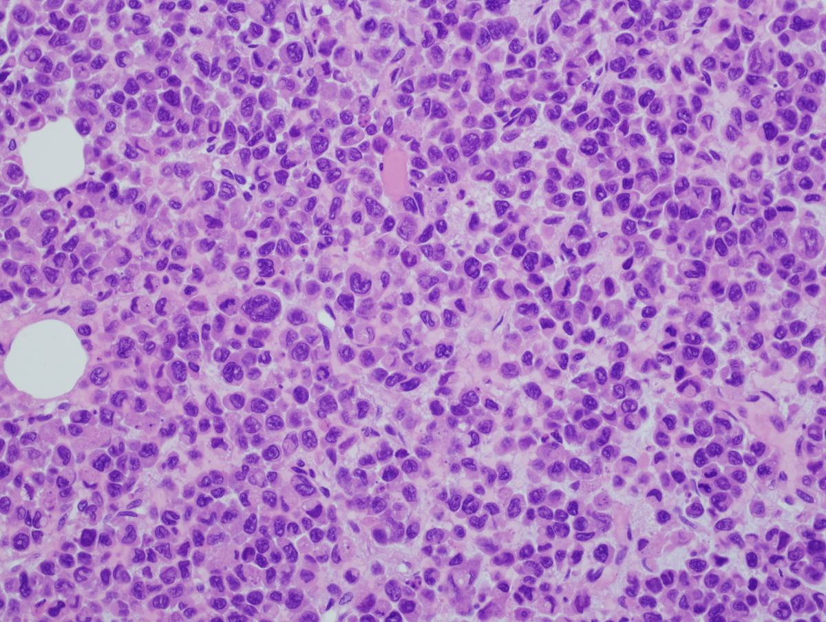 Figure 5. H&E stained section of the epidural mass, 400X.